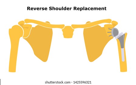 Reverse Shoulder Replacement. Shoulder Joint Replacement, Endoprosthetics. Osteoarthrosis Of The Shoulder Joint. Flat Design.