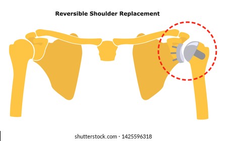 Reversible Shoulder Replacement. Shoulder Joint Replacement, Endoprosthetics. Osteoarthrosis Of The Shoulder Joint.  Flat Design.