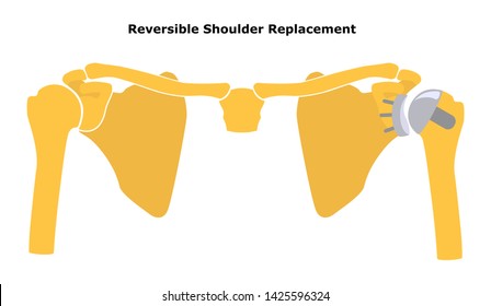 Reversible Shoulder Replacement. Shoulder Joint Replacement, Endoprosthetics. Osteoarthrosis Of The Shoulder Joint. Flat Design.