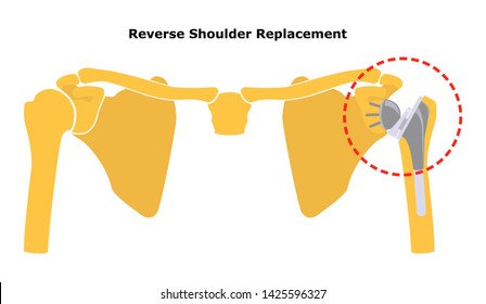 Reversible Shoulder Replacement. Shoulder Joint Replacement, Endoprosthetics. Osteoarthrosis Of The Shoulder Joint.  Flat Design.