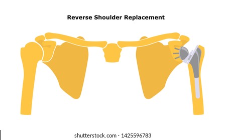 Reversible Shoulder Replacement. Shoulder Joint Replacement, Endoprosthetics. Osteoarthrosis Of The Shoulder Joint. Flat Design.