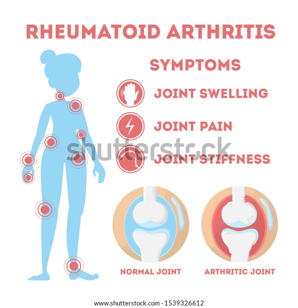 Rheumatism Infographic Bone Disease On Foot Stock Illustration 