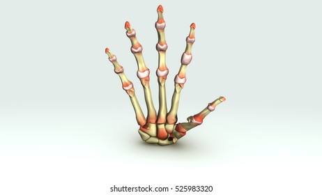 Rheumatoid Arthritis 3d Illustration