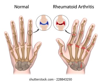 Rheumatoid Arthritis Of Hand