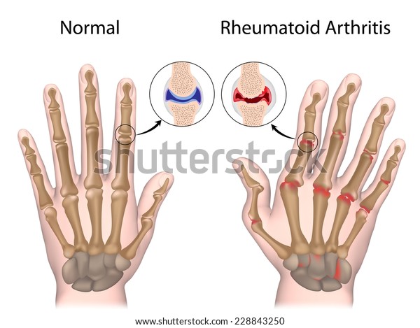 A mutatóujj rheumatoid arthritis - terma.hu