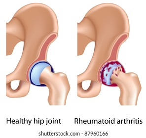 Rheumatoid Arthritis Of Hip Joint