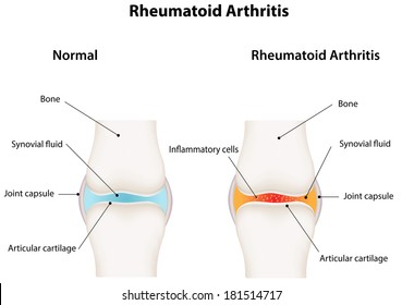 Rheumatoid Arthritis Synovial Joint