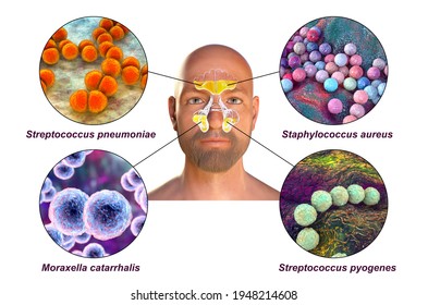 Rhinosinusitis Man Bacteria That Cause Sinusitis Stock Illustration ...