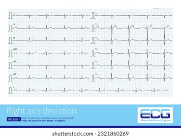 Right axis deviation can be seen both in right ventricular hypertrophy and in some healthy people, who have no ECG abnormalities except for right axis deviation.