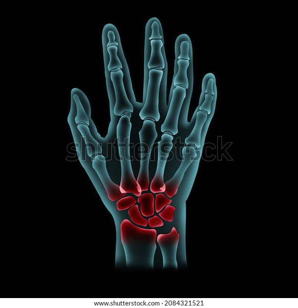Right bone\
hand​ isolated​ on​ black​ background.Wrist pain.X-Ray film for​\
check​ or​ analysis broken​ bone​ for​ medical, health care,\
protection​ or​ treatment.3D​\
illustration.