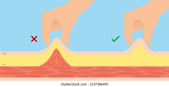 Right And Wrong Technique Of Insulin Injection Illustration