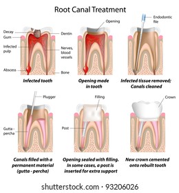 Root Canal Treatment