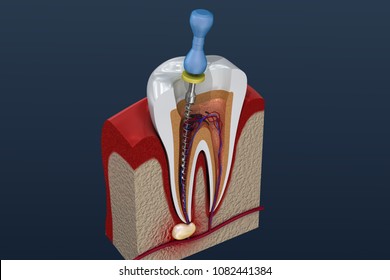 Root Canal Therapy Images Stock Photos Vectors Shutterstock