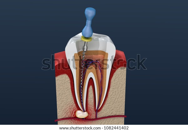 Root canal\
treatment process. 3D\
illustration