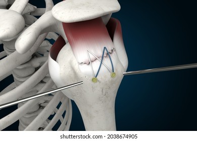 Rotator Cuff Repair Surgery 3D Rendering, Supraspinatus Tear, Shoulder Anatomy