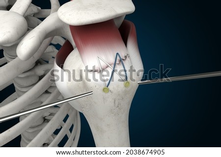 Rotator Cuff Repair Surgery 3D Rendering, Supraspinatus Tear, Shoulder Anatomy Imagine de stoc © 