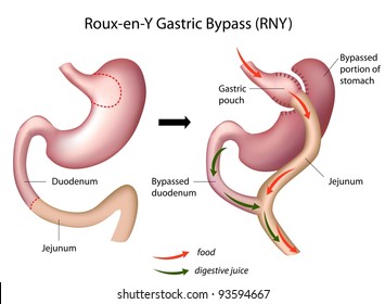 Roux-en-Y Gastric Bypass (RNY) Weight Loss Surgery