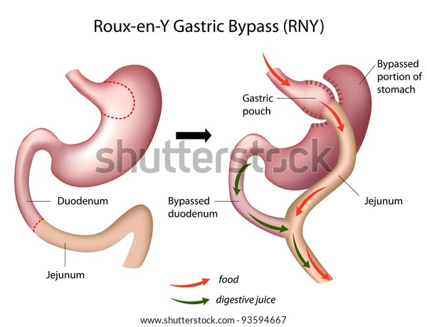 Rny Roux En Y胃バイパス 減量手術 のイラスト素材