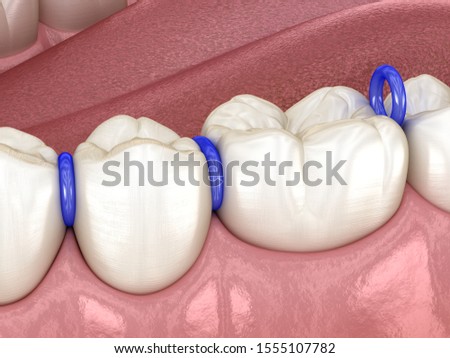 Rubber separator between teeth, preparation for braces placement. Medically accurate dental 3D illustration