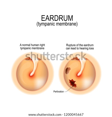 Ruptured eardrum. Anatomy of the humans eardrum. Healthy and perforated tympanic membrane. illustration for medical, science, and educational use Foto stock © 