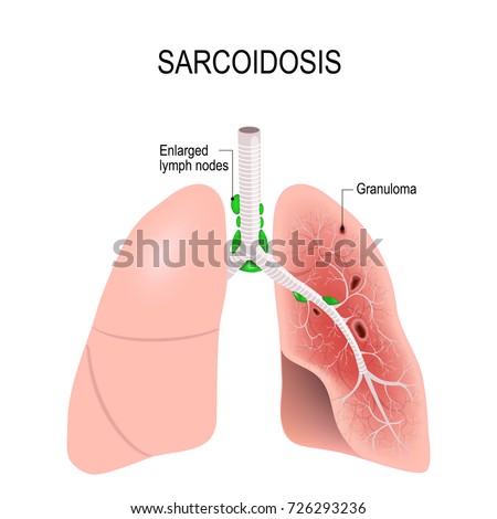 Sarcoidosis. Human's lungs with granulomas and Enlarged lymph nodes Stock photo © 