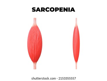 Sarcopenia Is The Loss Of Muscle Mass, A Common Occurrence After Age 50. 3D Illustration