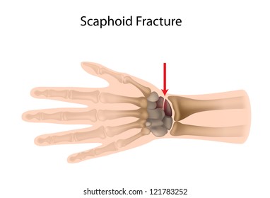 Scaphoid Wrist Fracture