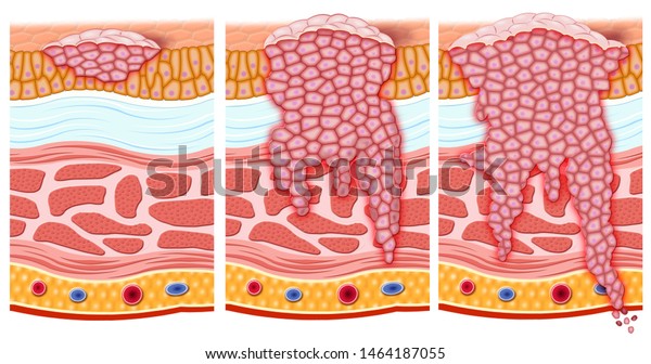 Schematic and descriptive illustration of the\
different stages of a bladder tumor, the progress through the\
different layers, and reaching the outer caoa the cancerous tumor\
is already\
invasive.