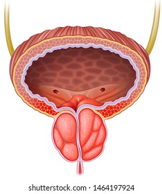 Schematic Descriptive Illustration Of The Enlargement And Inflammation Of The Male Prostate.