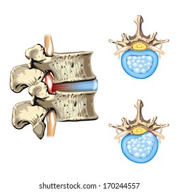 Schematic Drawing Of Hernia Of The Disc, Slipped Disc