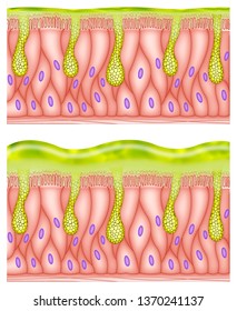 Schematic And Graphic Image Of Cells And Glands That Secrete Mucus In The Bronchial Tubes.