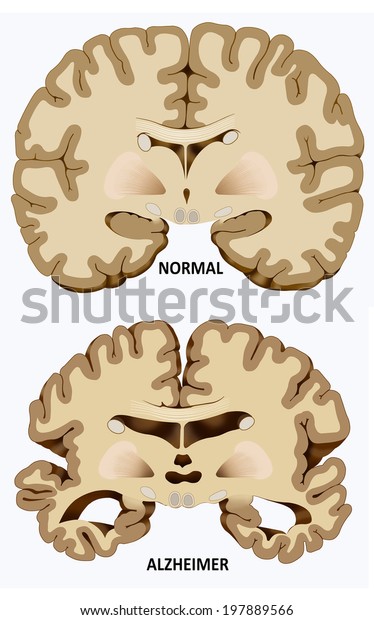 Schematic Illustration Dissection Normal Brain One Stock Illustration ...