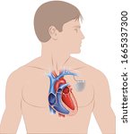 Schematic illustration of human figure with an implant of a unicameral pacemaker in the heart.