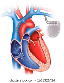 Schematic Illustration Of The Human Heart With A Bicameral Pacemaker.