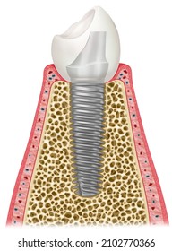 Schematic illustration of the process of an implant of a tooth, using a metal screw that replaces the part of the root of a missing tooth.