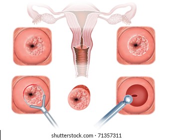 Schematic Illustration Of Surgery Of Cancer Of The Cervix.