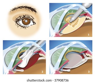 5,722 Cataract Surgery Images, Stock Photos & Vectors | Shutterstock