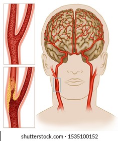 Scheme carotid artery diseased, this carries blood to the brain and face, the blood flow in this artery is blocked by fatty material called plaque, this reduces the blood supply to the brain.