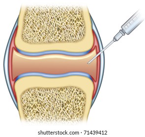 Torn cartilage in knee Images, Stock Photos & Vectors | Shutterstock