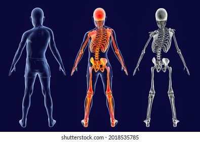 Scoliosis 3d Illustration Human Body Curved Stock Illustration ...