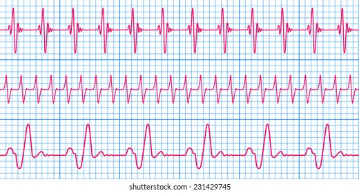 Seamless Pattern Of The Ekg Cardiograms Chart