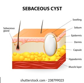 405 Sebaceous cyst Images, Stock Photos & Vectors | Shutterstock