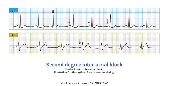 266 Atrioventricular node Images, Stock Photos & Vectors | Shutterstock