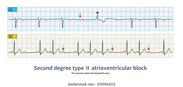 In second degree type Ⅱ atrioventricular block, PR interval was fixed with QRS wave shedding, and the block site was usually his bundle-Purkinje system.