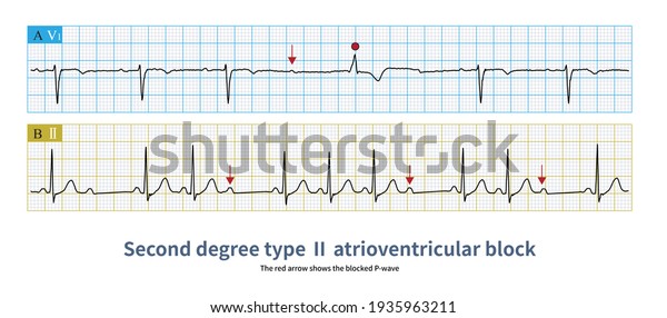 Second Degree Type Atrioventricular Block Pr Stock Illustration 1935963211