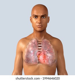 Secondary Tuberculosis In Lungs, Apical Nodule, 3D Illustration. Lung Tuberculosis