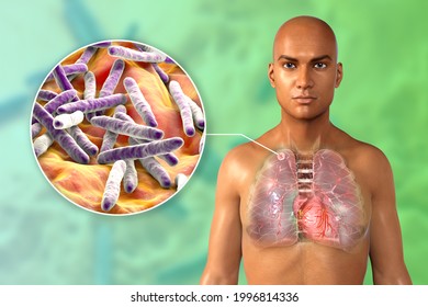 Secondary Tuberculosis In Lungs, Apical Nodule, 3D Illustration. Lung Tuberculosis And Close-up View Of Bacteria Mycobacterium Tuberculosis