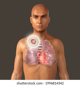 Secondary Tuberculosis In Lungs, Apical Nodule, 3D Illustration. Lung Tuberculosis