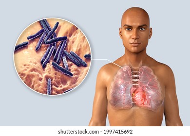 Secondary Tuberculosis In Lungs, Apical Nodule, 3D Illustration. Lung Tuberculosis And Close-up View Of Bacteria Mycobacterium Tuberculosis