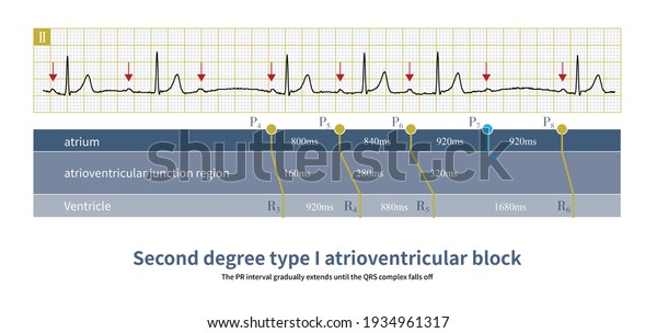 Seconddegree Type 1 Atrioventricular Block Pr Stock Illustration ...